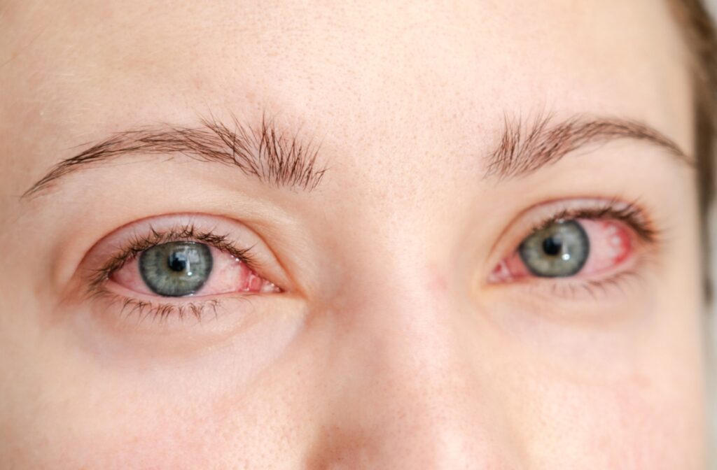 A close-up image of a person's red eyes due to allergies.