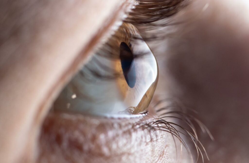 Close-up side view of an eye with a cone-shaped cornea, showing how keratoconus can affect the front surface of the eye.